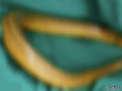 听信偏方治便秘 沐鸣代理招商男子将活黄鳝塞入肛门险丧命