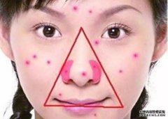 牙籤戳「危险三角区」沐鸣娱乐客户端登录暗疮 男子头痛半年揭细菌感染致脑脓肿