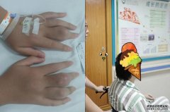 沐鸣代理招商广东18岁男生日日饮奶茶 手脚关节长痛风石无法走路