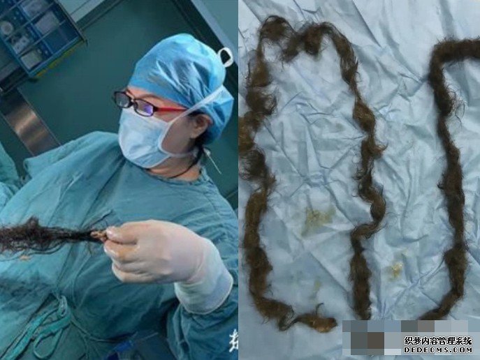 武汉女卵巢藏畸胎瘤 沐鸣直属总代医生取出2米毛髮